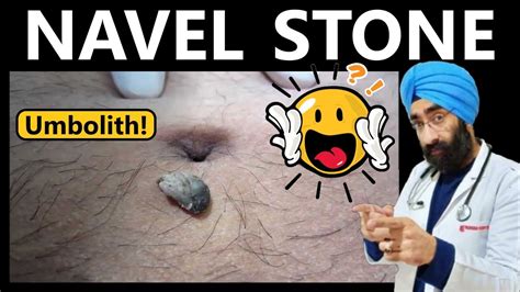 navel stone symptoms|Navel Stones: What to Know About This Uncommon Condition